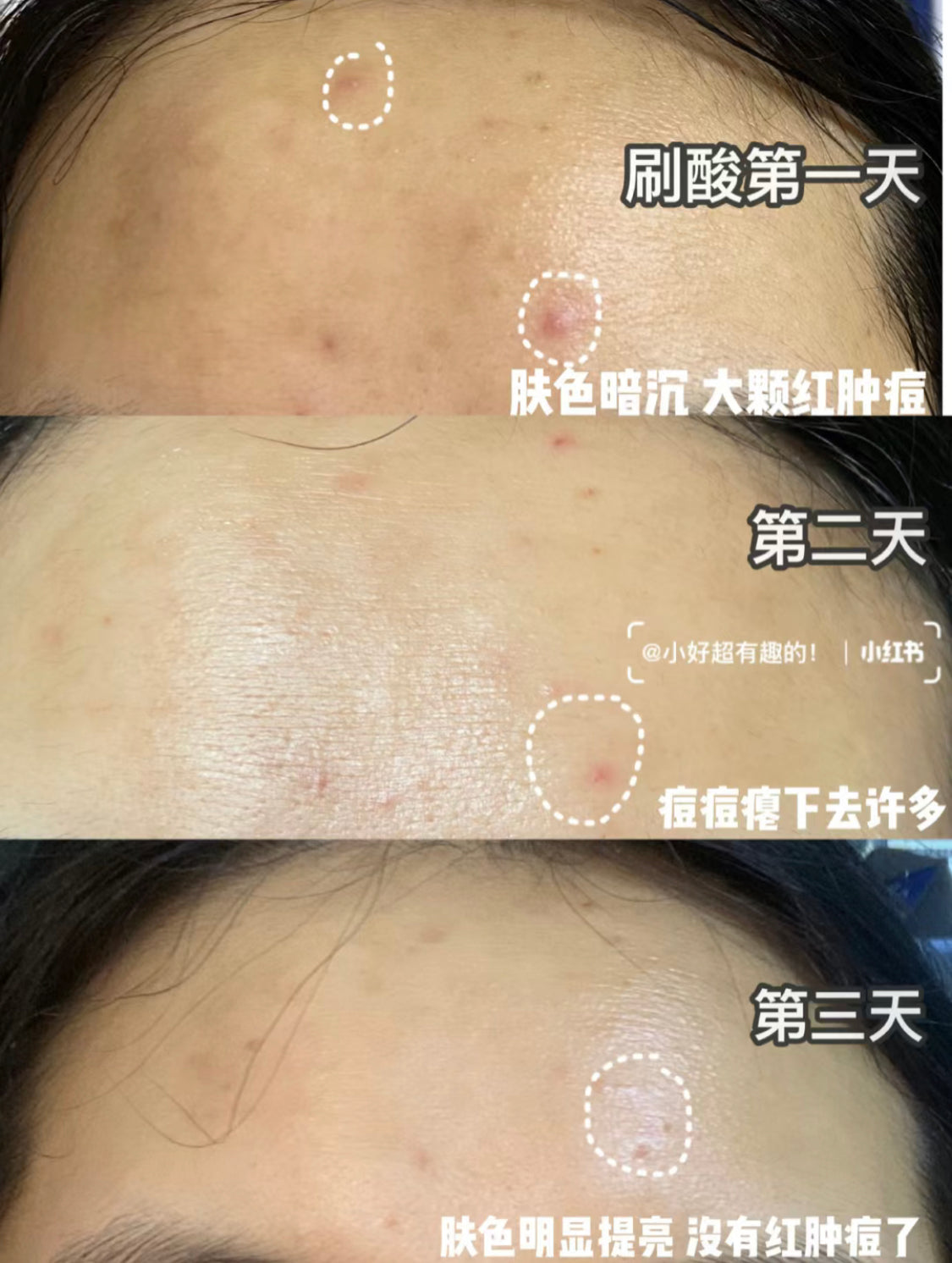 The Ordinary |AHA 30% +BHA 2% |果酸精華 |清潔毛孔|30ML