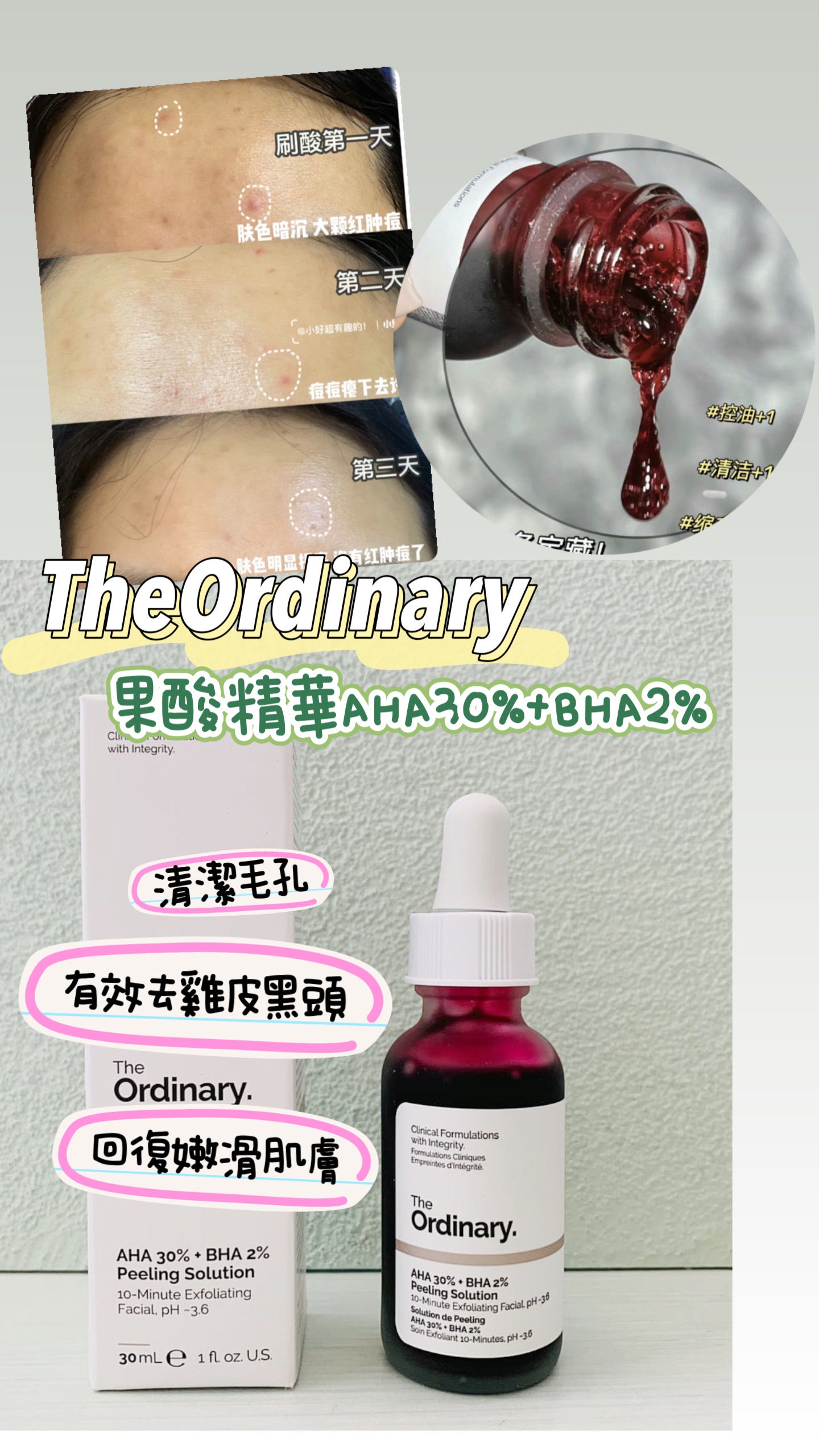 The Ordinary |AHA 30% +BHA 2% |果酸精華 |清潔毛孔|30ML